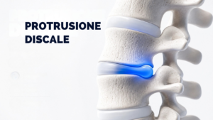 Immagini di una Protrusione discale